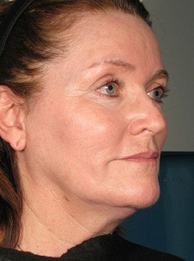 Cheek Fillerzz Before & After