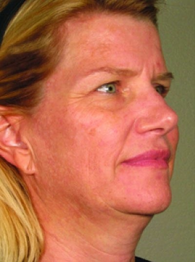 Cheek Fillerzz Before & After