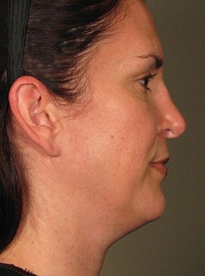 Cheek Fillerzz Before & After