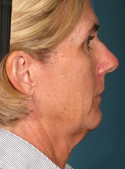 Cheek Fillerzz Before & After