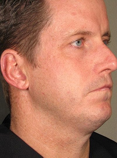 Cheek Fillerzz Before & After