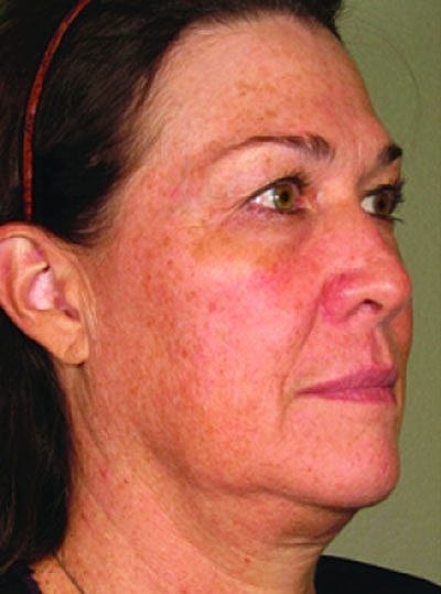 Cheek Fillerzz Before & After