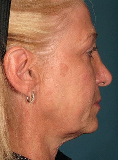 Cheek Fillerzz Before & After