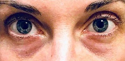 Cheek Fillerzz Before & After