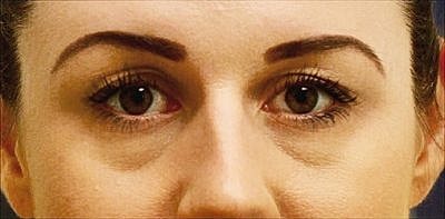 Cheek Fillerzz Before & After