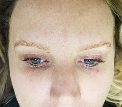 Cheek Fillerzz Before & After