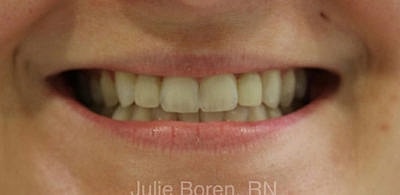 Cheek Fillerzz Before & After