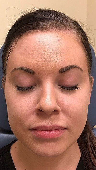 Cheek Fillerzz Before & After