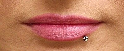 Cheek Fillerzz Before & After