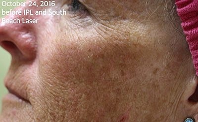 Cheek Fillerzz Before & After