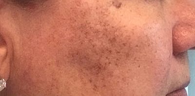 Cheek Fillerzz Before & After