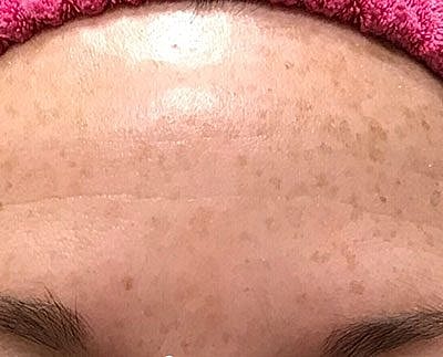 Cheek Fillerzz Before & After