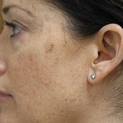 Cheek Fillerzz Before & After