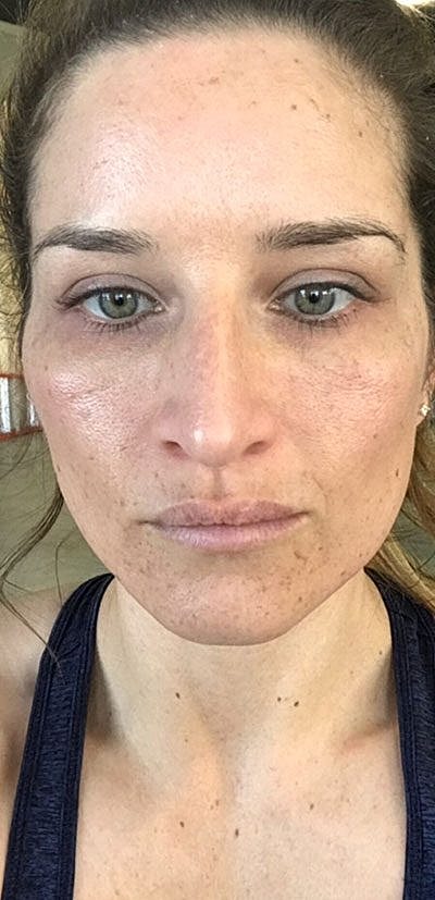 Cheek Fillerzz Before & After