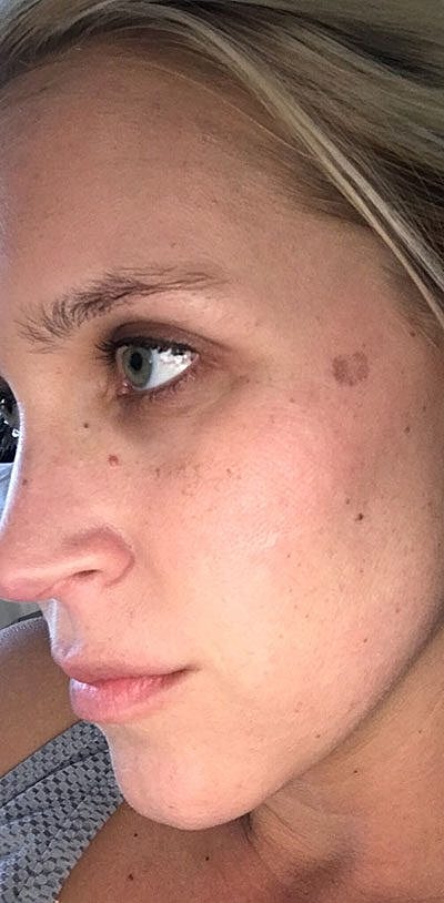 Cheek Fillerzz Before & After