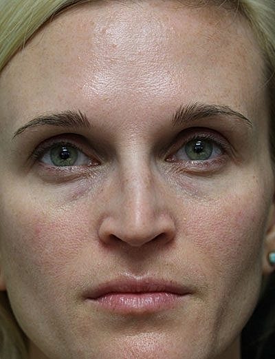 Cheek Fillerzz Before & After