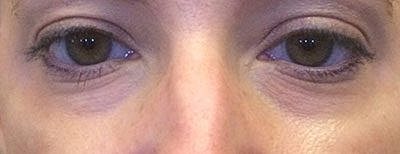 Cheek Fillerzz Before & After