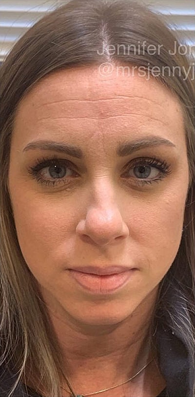 Cheek Fillerzz Before & After