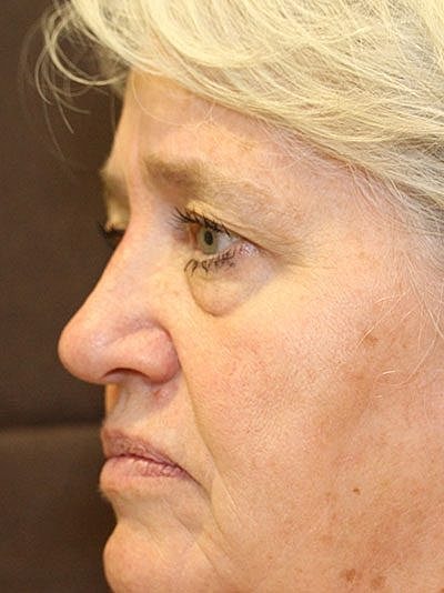 Cheek Fillerzz Before & After