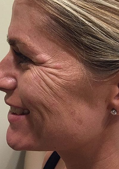 Cheek Fillerzz Before & After