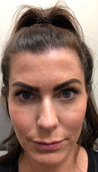 Cheek Fillerzz Before & After